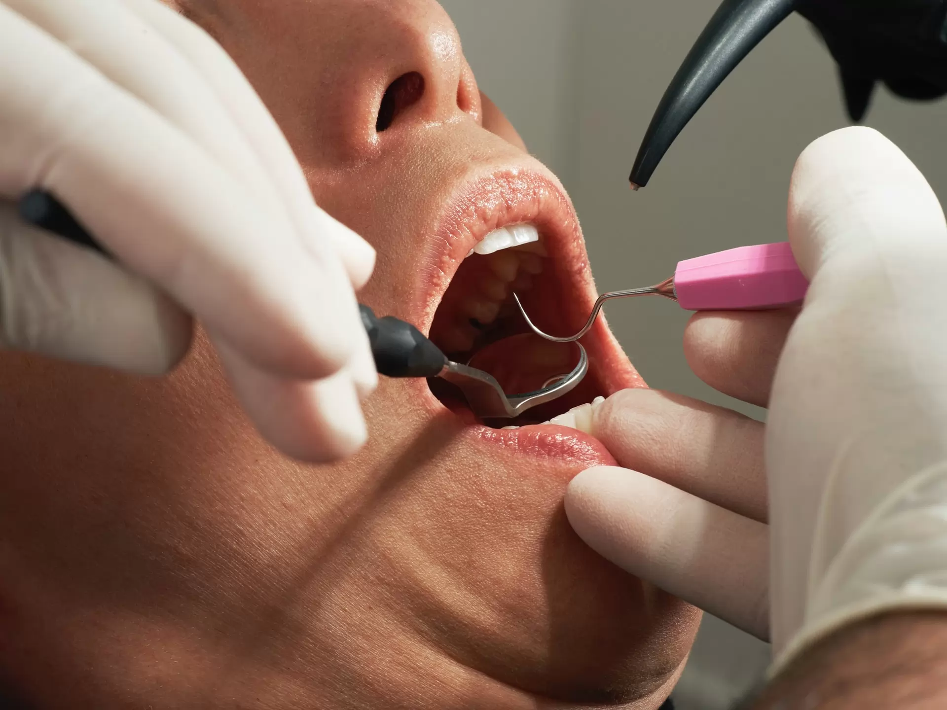 el mercado de los implantes dentales