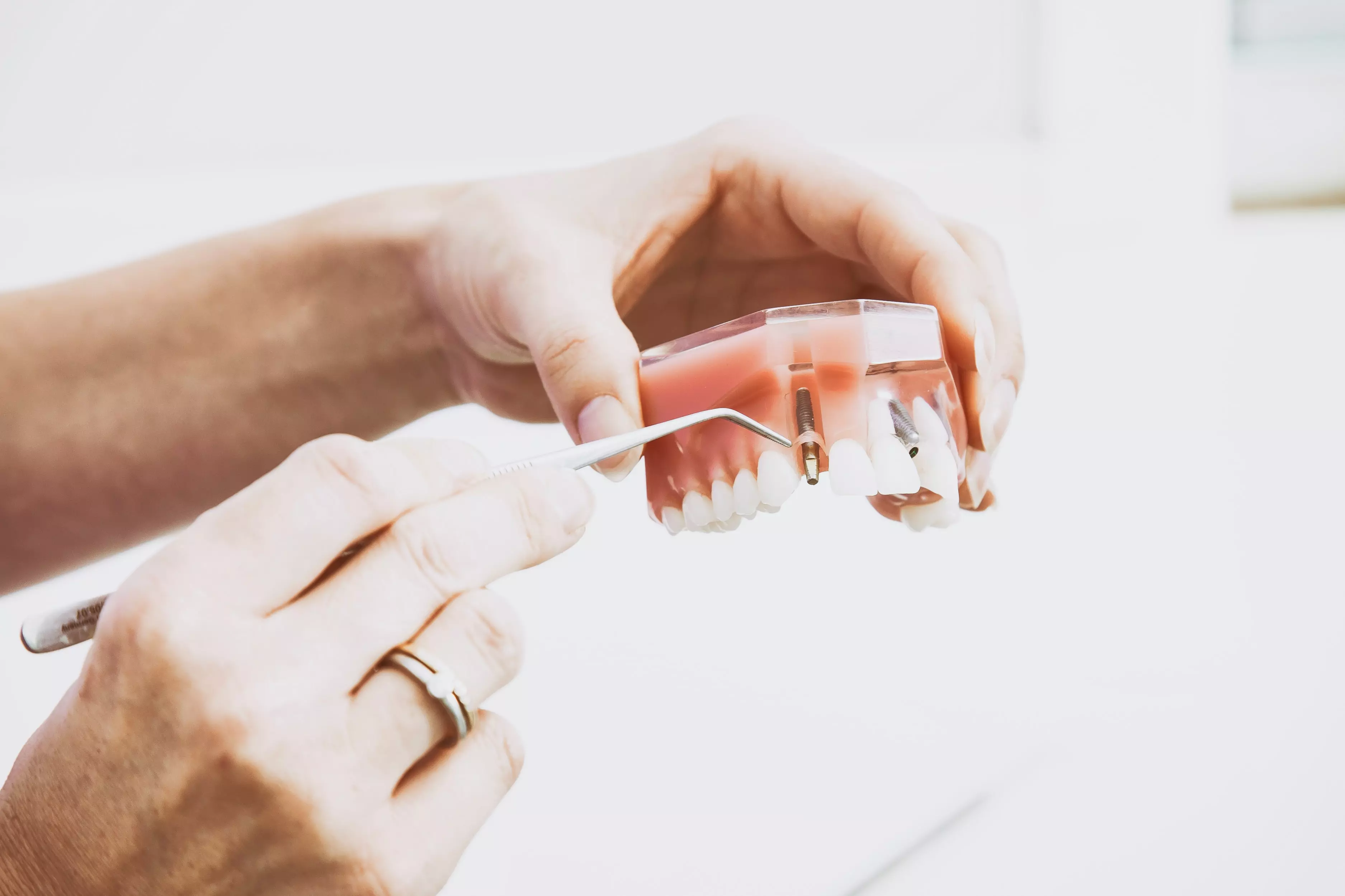 the dental implant market