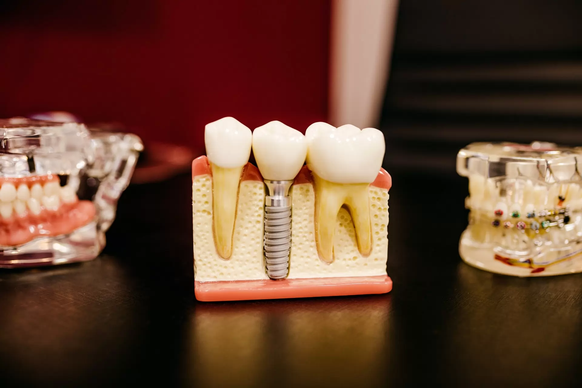 The market for dental implants and prostheses